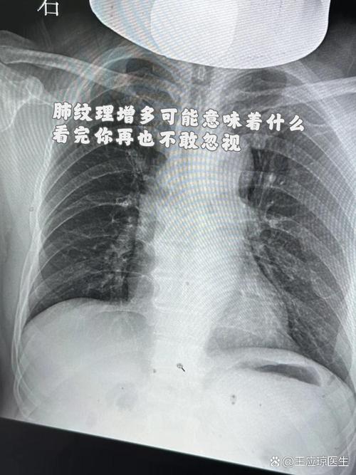 儿童双肺纹理增多是生病了吗？-第3张图片-中州医学会