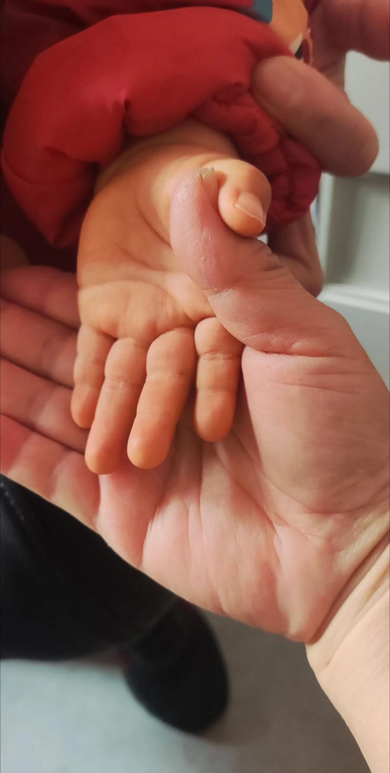 儿童手心脚心发热是何原因？-第2张图片-中州医学会