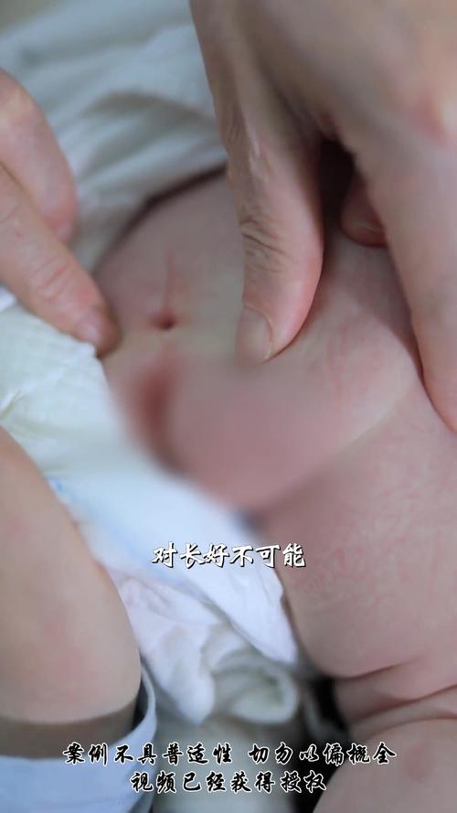 新生儿隐形脊柱裂症状有哪些？-第1张图片-中州医学会