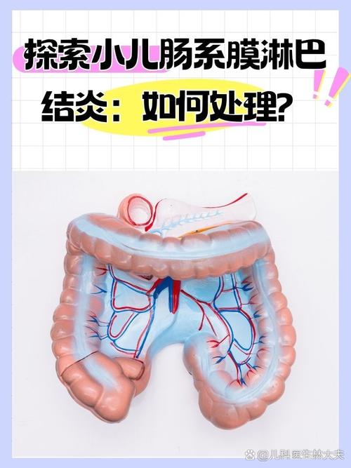 儿童肠系膜淋巴结炎能自愈吗？-第1张图片-中州医学会