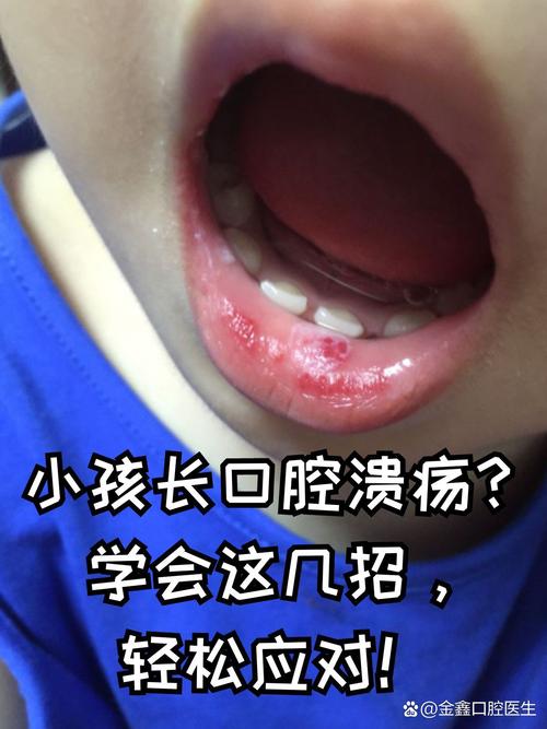 儿童反复口腔溃疡是缺维生素还是免疫力差？-第1张图片-中州医学会