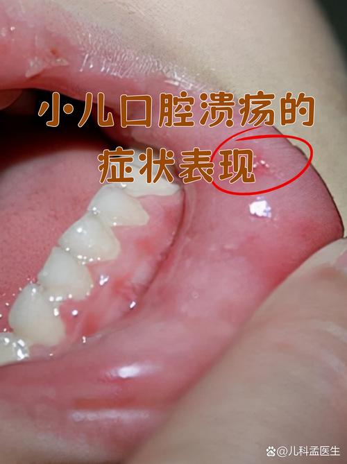 儿童反复口腔溃疡是缺维生素还是免疫力差？-第2张图片-中州医学会