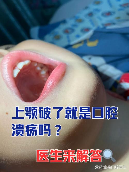 儿童反复口腔溃疡是缺维生素还是免疫力差？-第3张图片-中州医学会
