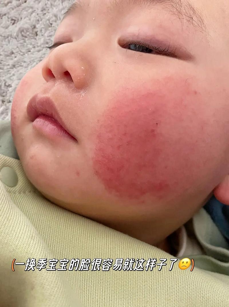 新生儿脸上有湿疹,能洗脸吗?-第3张图片-中州医学会 新生儿脸上有湿疹,能洗脸吗?-第3张图片-中州医学会