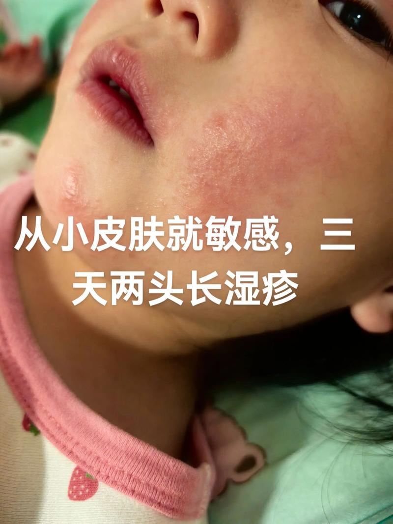 新生儿脸上有湿疹,能洗脸吗?-第2张图片-中州医学会 新生儿脸上有湿疹,能洗脸吗?-第2张图片-中州医学会