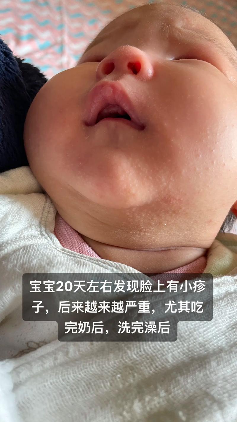 新生儿湿疹严重不治会怎样?-第2张图片-中州医学会 新生儿湿疹严重不治会怎样?-第2张图片-中州医学会