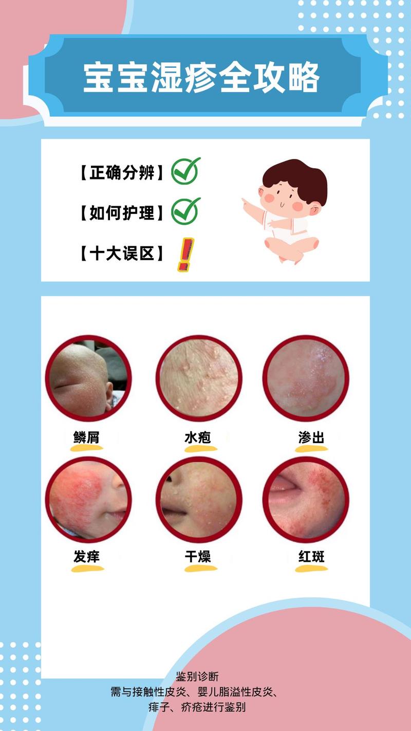 新生儿湿疹严重不治会怎样?-第3张图片-中州医学会 新生儿湿疹严重不治会怎样?-第3张图片-中州医学会