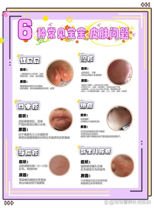 新生儿湿疹严重不治会怎样?-第1张图片-中州医学会 新生儿湿疹严重不治会怎样?-第1张图片-中州医学会