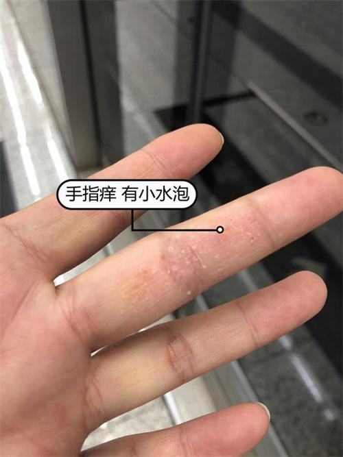 儿童手指缝起小水泡是咋回事?-第1张图片-中州医学会 儿童手指缝起小水泡是咋回事?-第1张图片-中州医学会