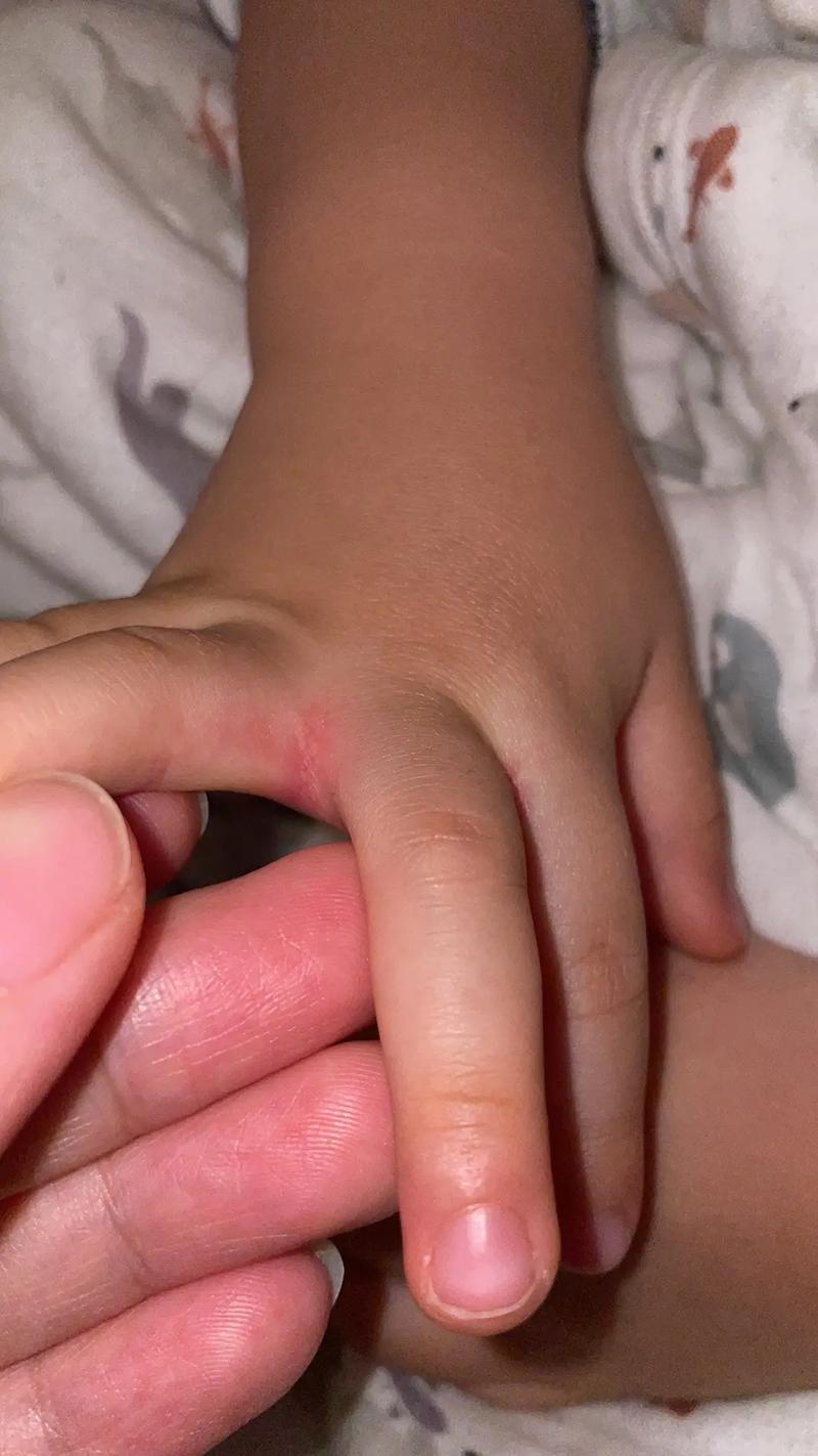 儿童手指缝起小水泡是咋回事?-第2张图片-中州医学会 儿童手指缝起小水泡是咋回事?-第2张图片-中州医学会