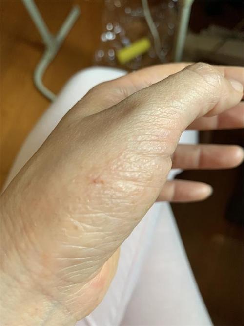 儿童手指缝起小水泡是咋回事？-第3张图片-中州医学会