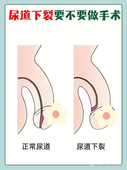 新生儿尿道口下裂具体表现有哪些？-第2张图片-中州医学会