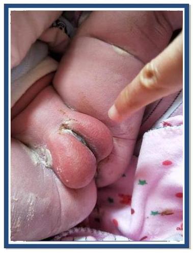 新生儿尿道口下裂具体表现有哪些？-第1张图片-中州医学会