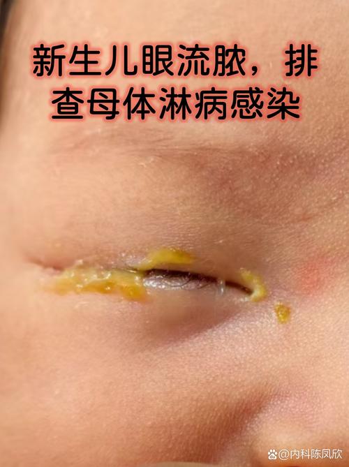 新生儿眼睛进异物该如何处理？-第3张图片-中州医学会