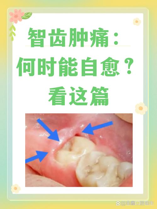 孕期智齿肿痛，能用药吗？-第1张图片-中州医学会