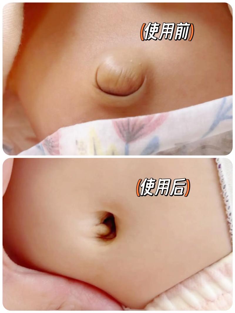 新生儿肚脐凸出是啥原因？-第1张图片-中州医学会