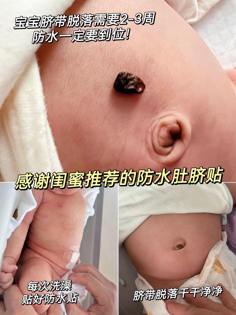 新生儿肚脐凸出是啥原因？-第3张图片-中州医学会
