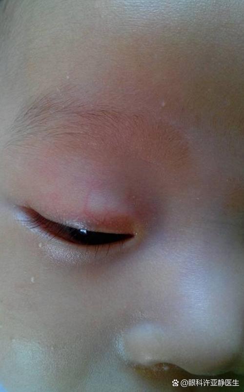 新生儿眼皮红血丝是何原因？-第2张图片-中州医学会