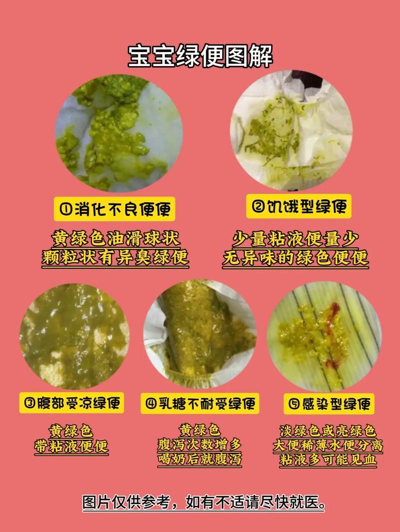 新生儿黄绿大便异常吗？-第3张图片-中州医学会