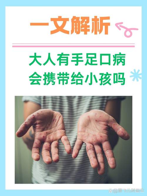 儿童手足口病会传染给大人吗？-第1张图片-中州医学会