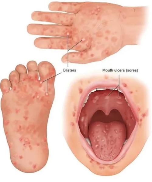 儿童手足口病会传染给大人吗？-第2张图片-中州医学会