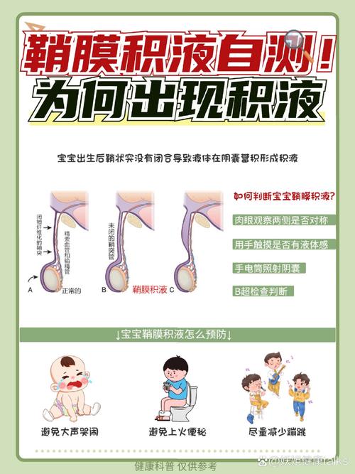 新生儿鞘膜积液因何形成?-第1张图片-中州医学会 新生儿鞘膜积液因何形成?-第1张图片-中州医学会