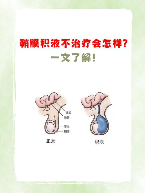 新生儿鞘膜积液因何形成？-第3张图片-中州医学会