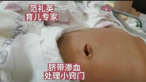 新生儿脐带掉了还出血怎么办-第3张图片-中州医学会