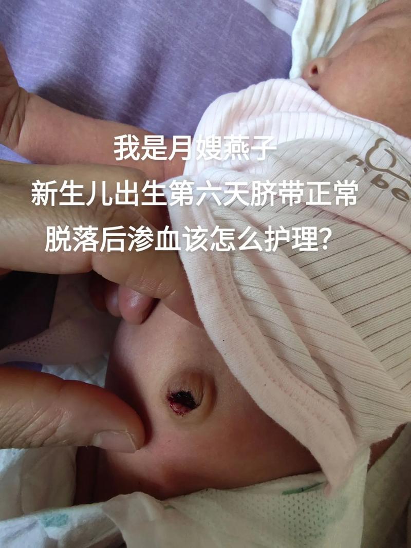 新生儿脐带掉了还出血怎么办-第2张图片-中州医学会