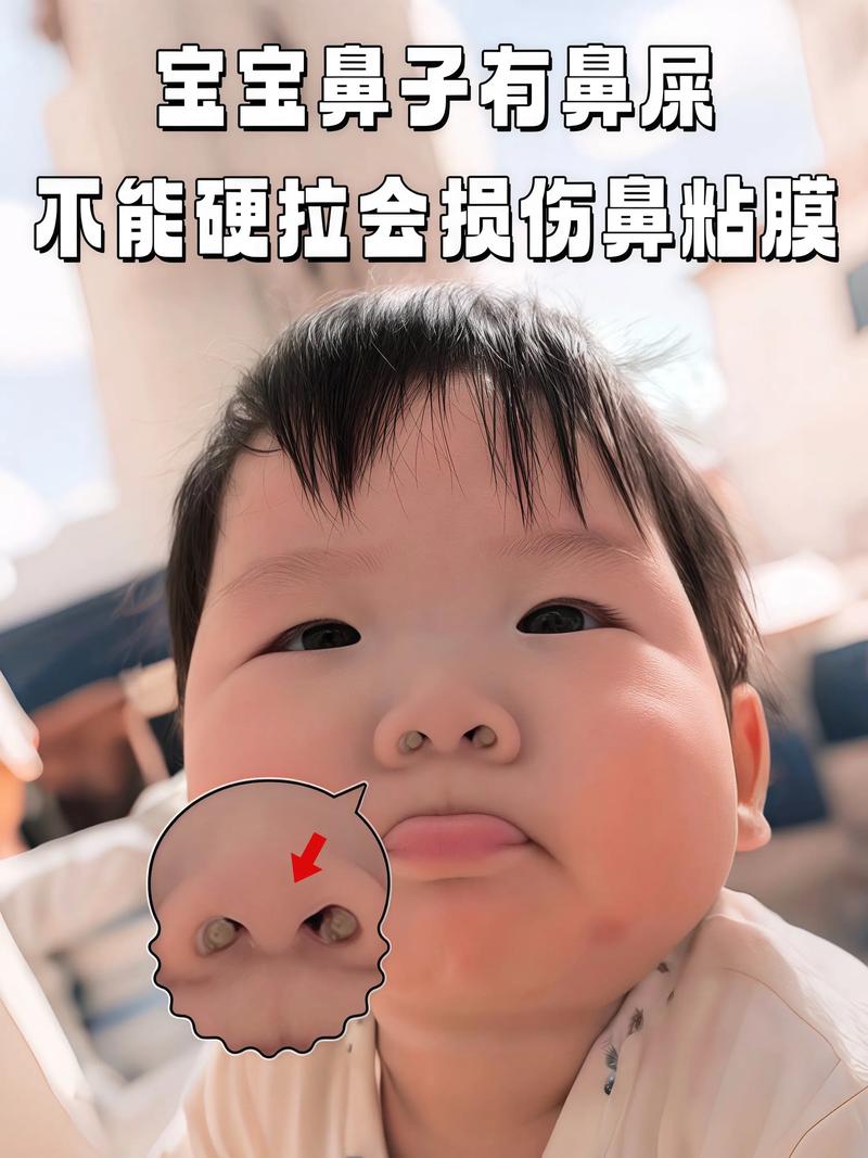 新生儿鼻屎堵鼻怎么办？-第2张图片-中州医学会