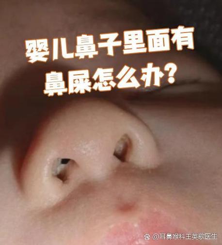 新生儿鼻屎堵鼻怎么办？-第3张图片-中州医学会