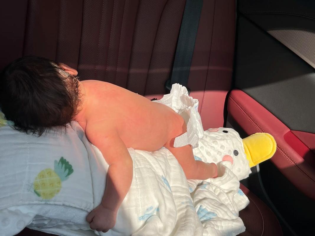 新生儿黄疸晒太阳晒哪个部位？-第3张图片-中州医学会