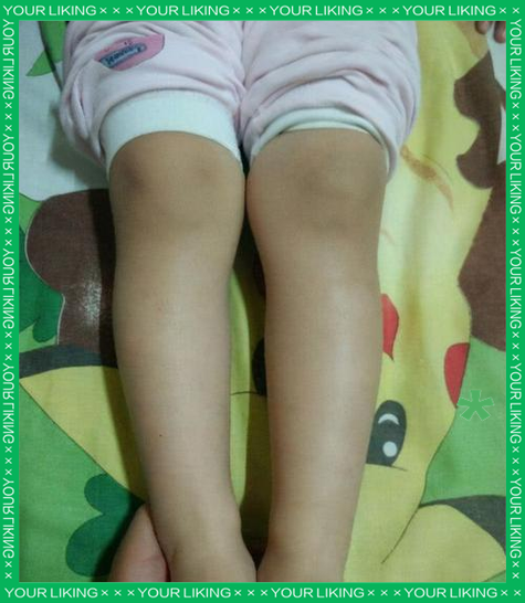 9岁儿童一腿长一腿短，是何原因导致？-第1张图片-中州医学会