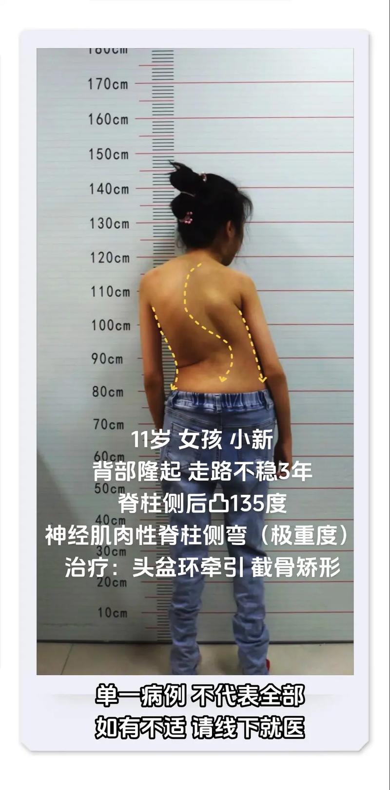 儿童强直性脊柱炎早期症状有哪些？-第1张图片-中州医学会