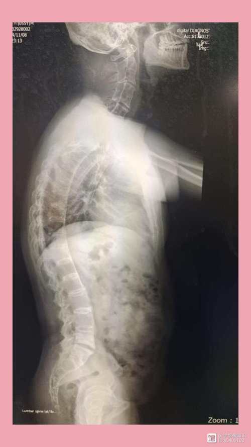 儿童强直性脊柱炎早期症状有哪些？-第3张图片-中州医学会