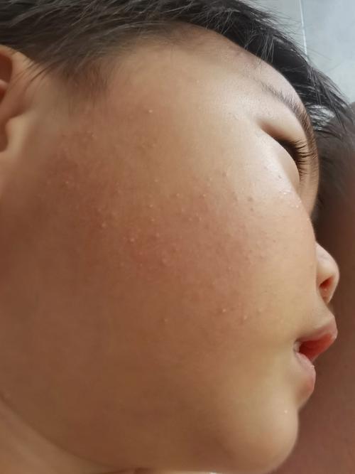 新生儿脸上小红疙瘩是啥原因？-第1张图片-中州医学会