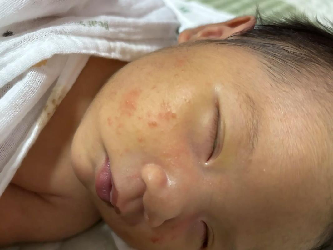 新生儿脸上小红疙瘩是啥原因？-第3张图片-中州医学会