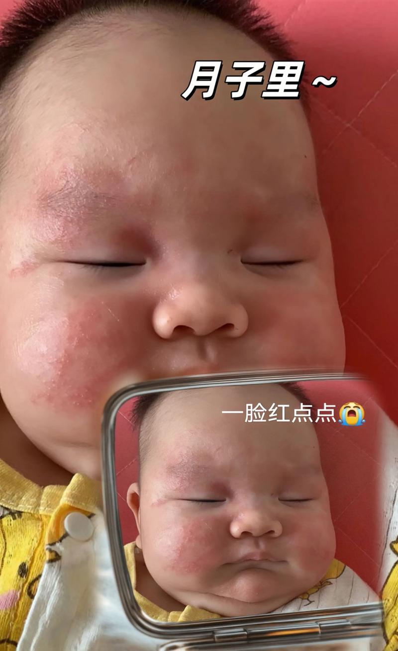新生儿脸上小红疙瘩是啥原因？-第2张图片-中州医学会