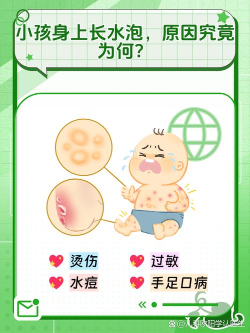 儿童身上起水泡是怎么回事-第1张图片-中州医学会 儿童身上起水泡是怎么回事-第1张图片-中州医学会