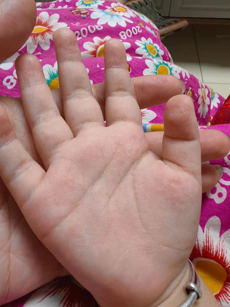 儿童身上起水泡是怎么回事-第3张图片-中州医学会