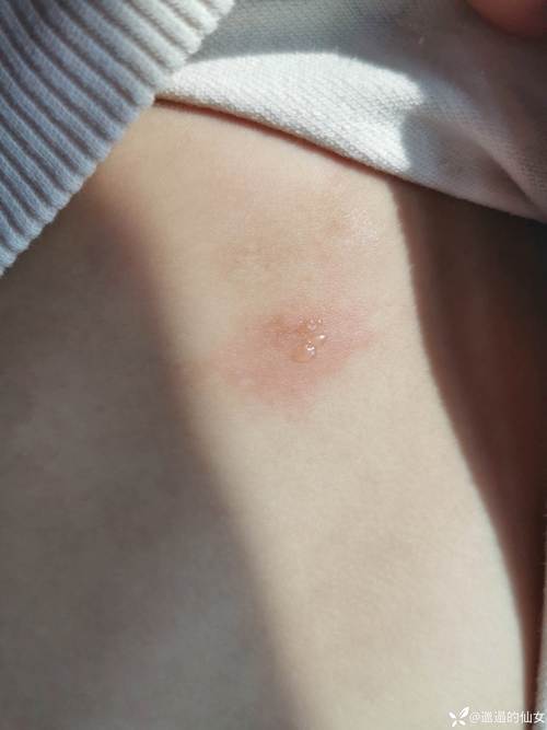 儿童身上起水泡是怎么回事-第2张图片-中州医学会