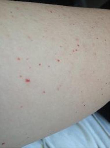 儿童皮下出血点是何原因？-第2张图片-中州医学会