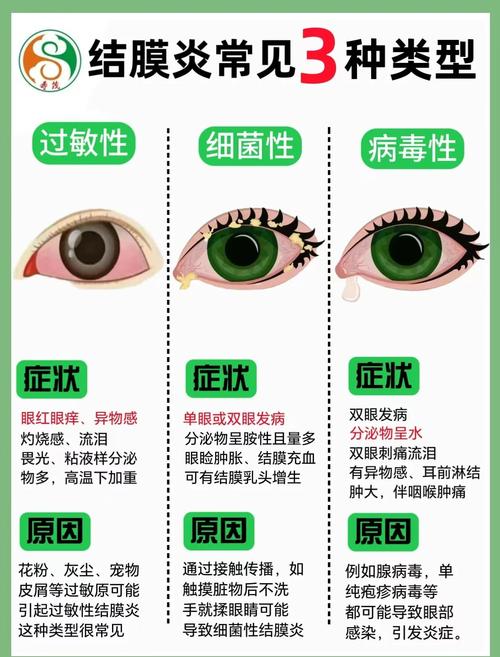 儿童过敏性结膜炎究竟多久能好？-第3张图片-中州医学会