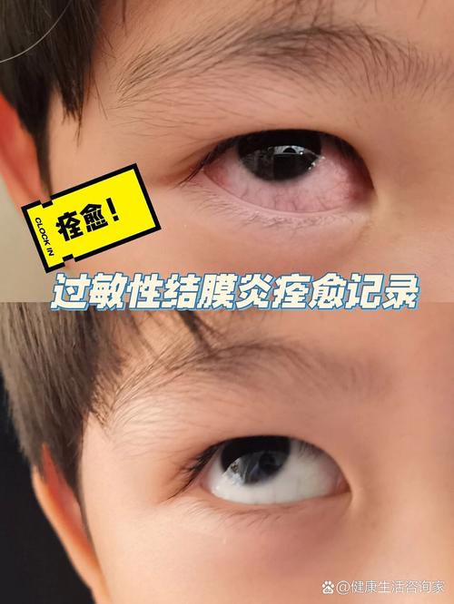 儿童过敏性结膜炎究竟多久能好?-第1张图片-中州医学会 儿童过敏性结膜炎究竟多久能好?-第1张图片-中州医学会