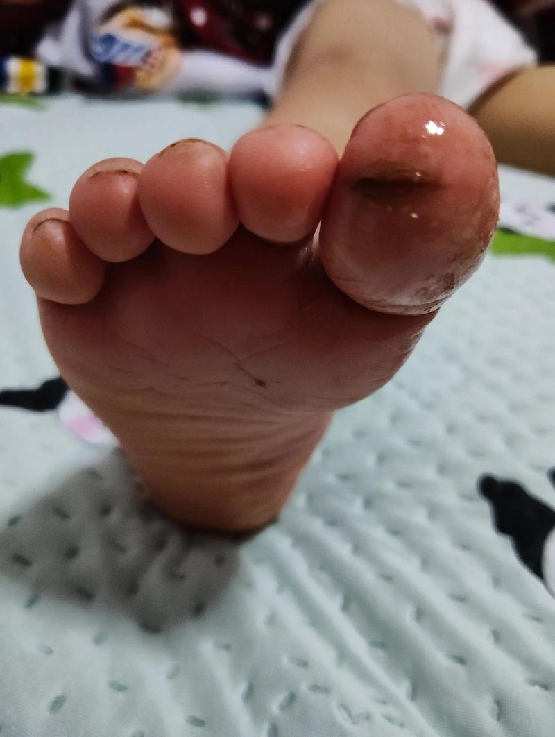 儿童脚趾脱皮是缺乏维生素还是皮肤病？-第2张图片-中州医学会