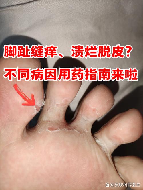 儿童脚趾脱皮是缺乏维生素还是皮肤病？-第1张图片-中州医学会