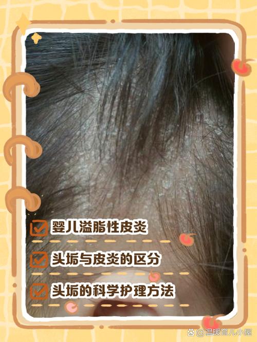 新生儿头发为何油油的？-第3张图片-中州医学会