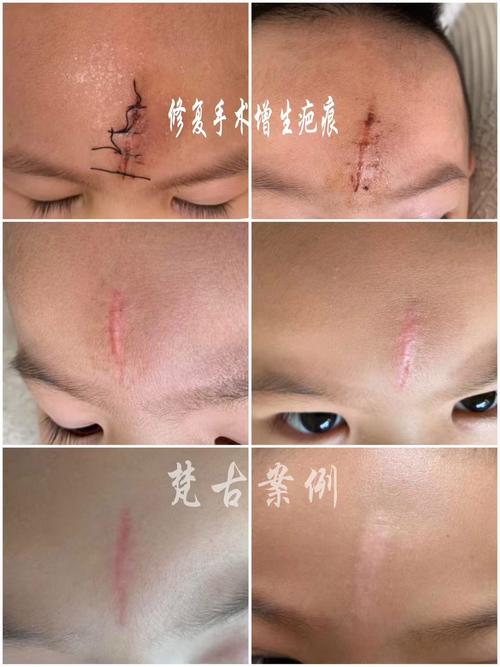 儿童烫伤疤痕增生如何修复-第2张图片-中州医学会