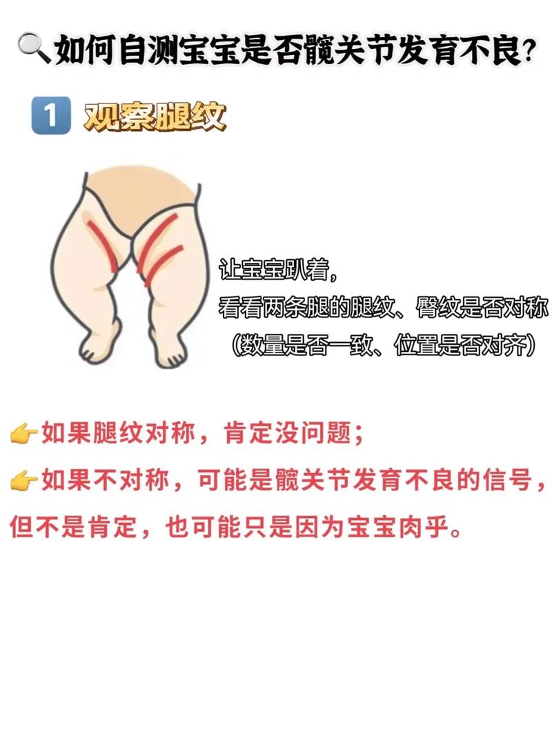 新生儿髋关节发育不良有哪些症状？-第2张图片-中州医学会