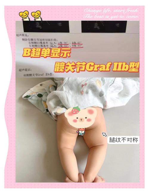 新生儿髋关节发育不良有哪些症状？-第1张图片-中州医学会